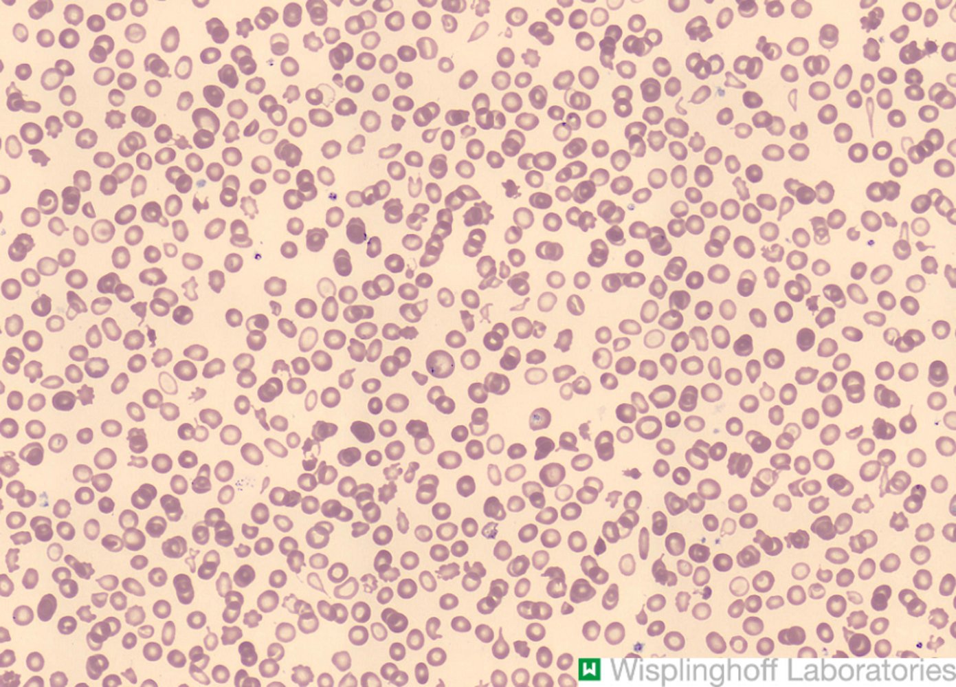 Anisocytosis and poikilocytosis