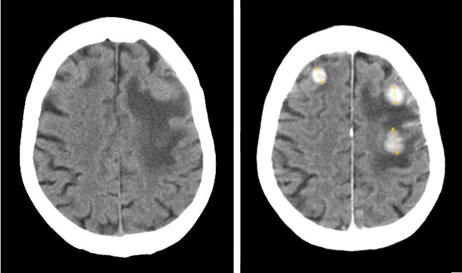 Cerebral metastases