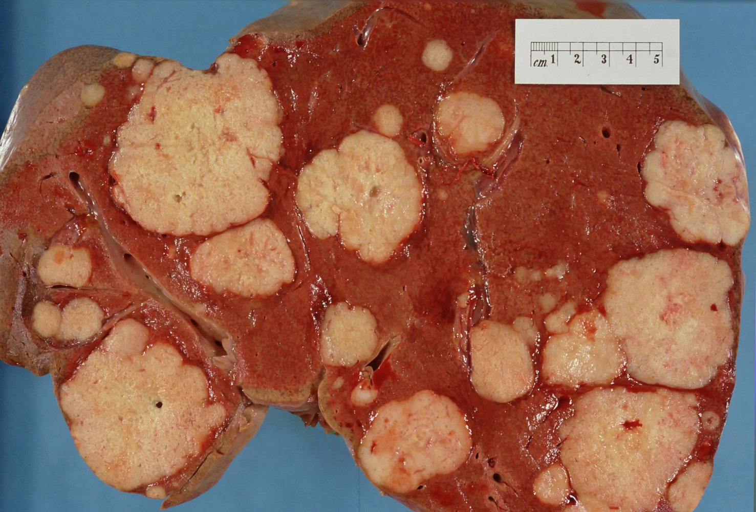 Liver metastasis from pancreatic carcinoma