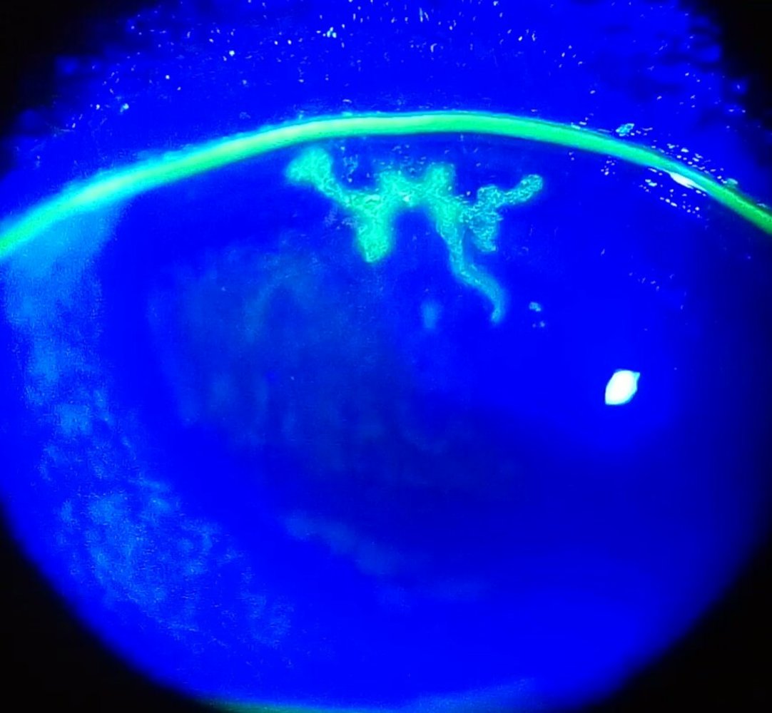 Herpes simplex keratitis