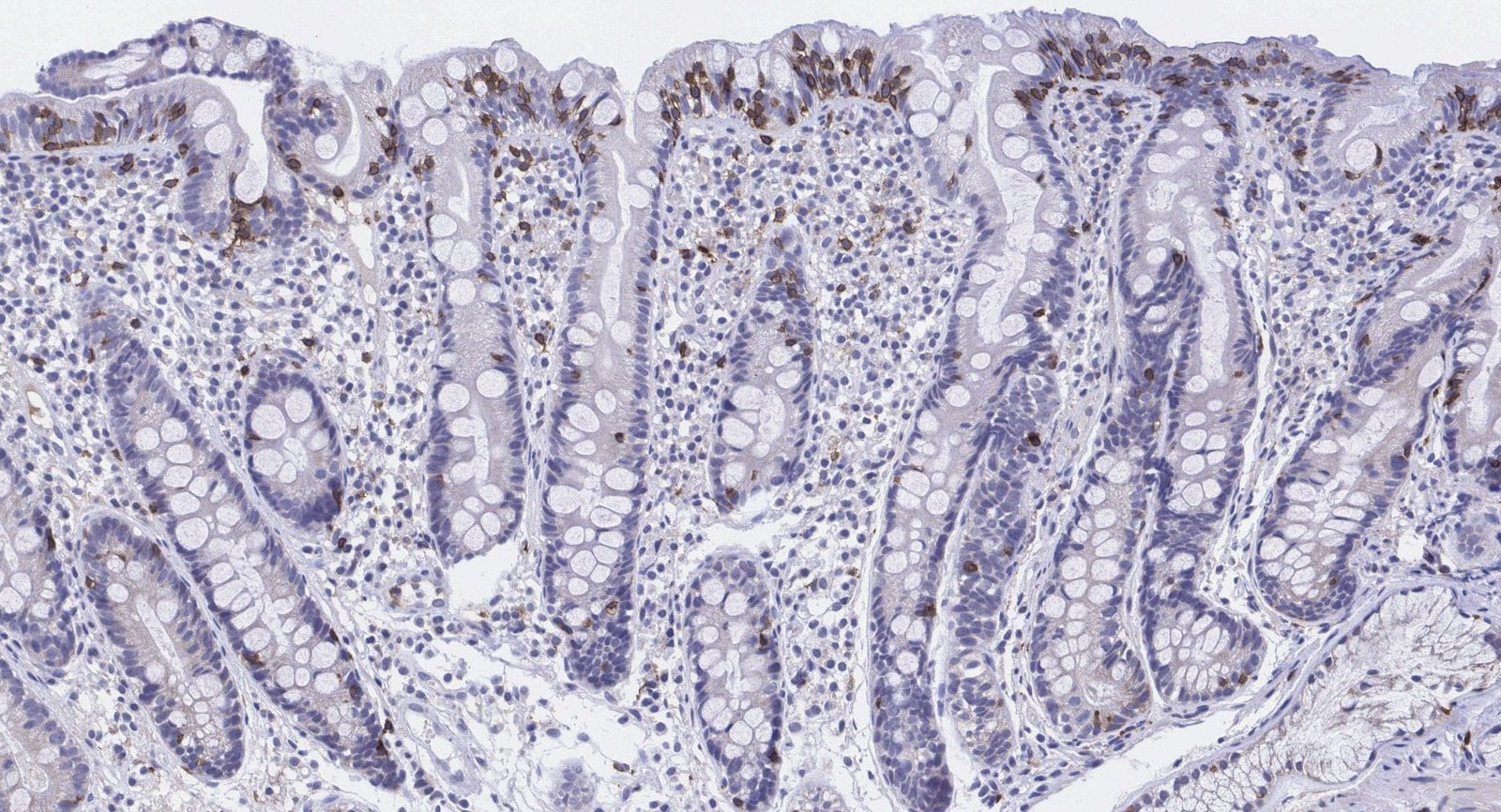 Biopsy in celiac disease