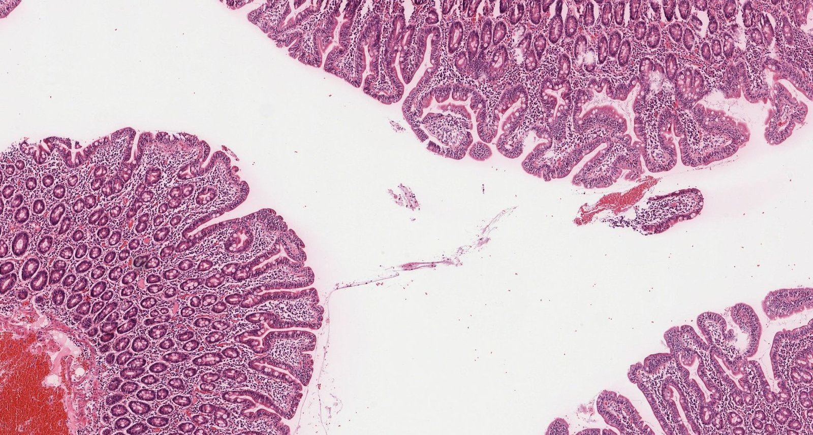 Histopathological changes in celiac disease