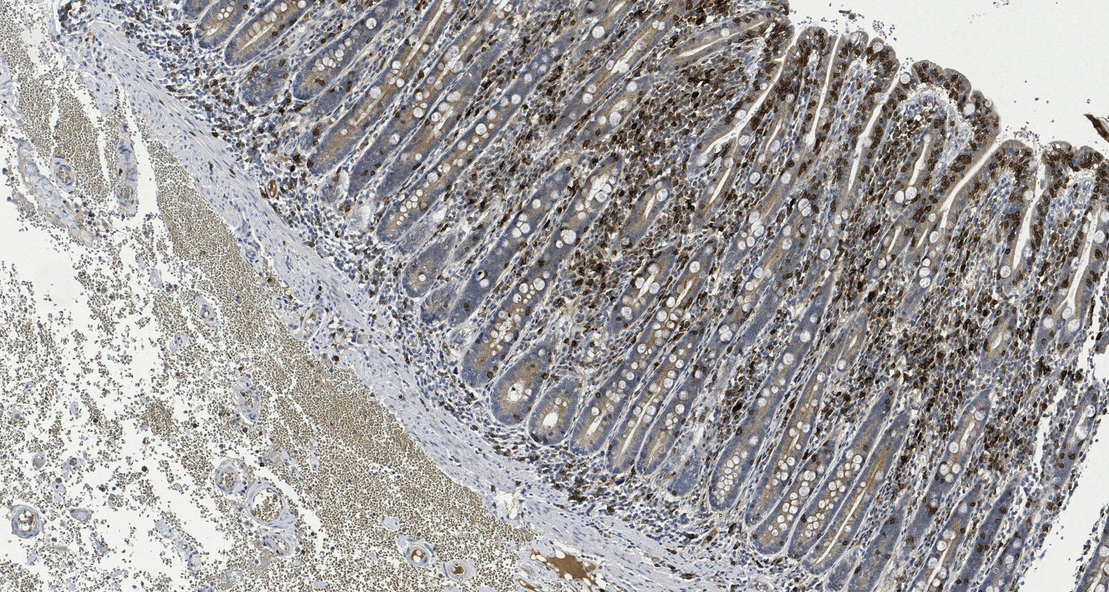Celiac disease (resection specimen, CD8)