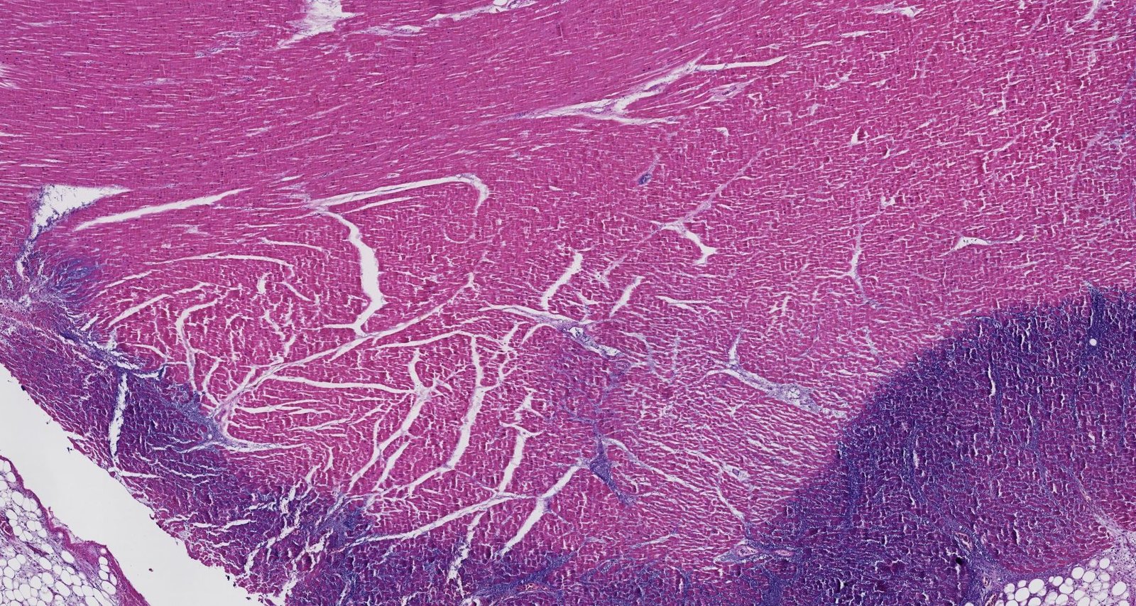 Line of demarcation in myocardial infarction