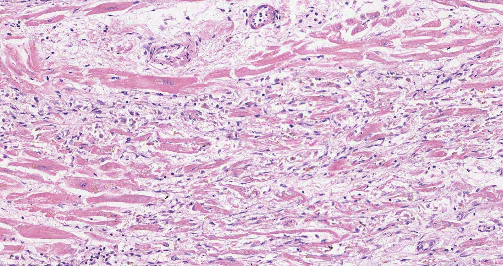 Myocardial infarction (granulation)