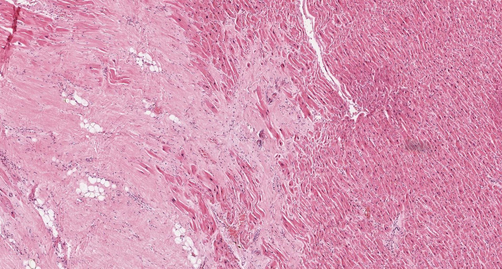 Scar formation after myocardial infarction