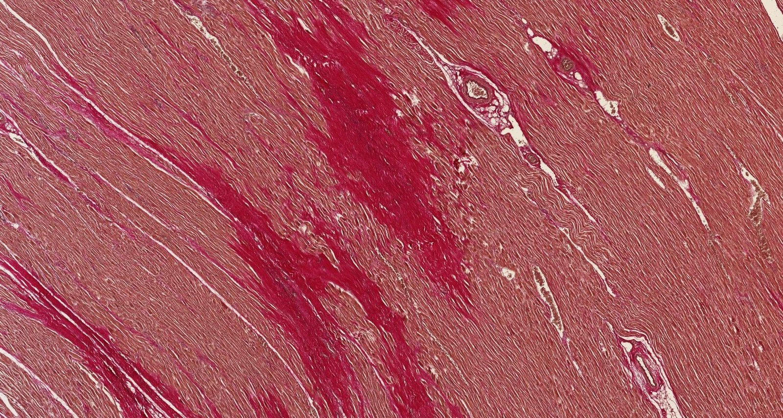 Scar formation after myocardial infarction