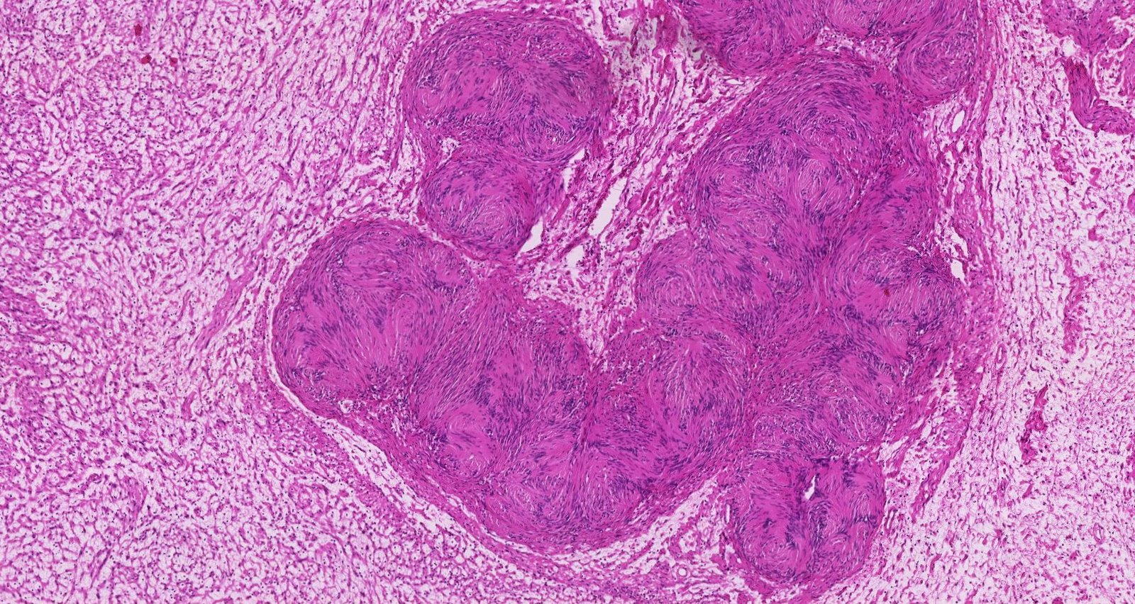 Acoustic neuroma