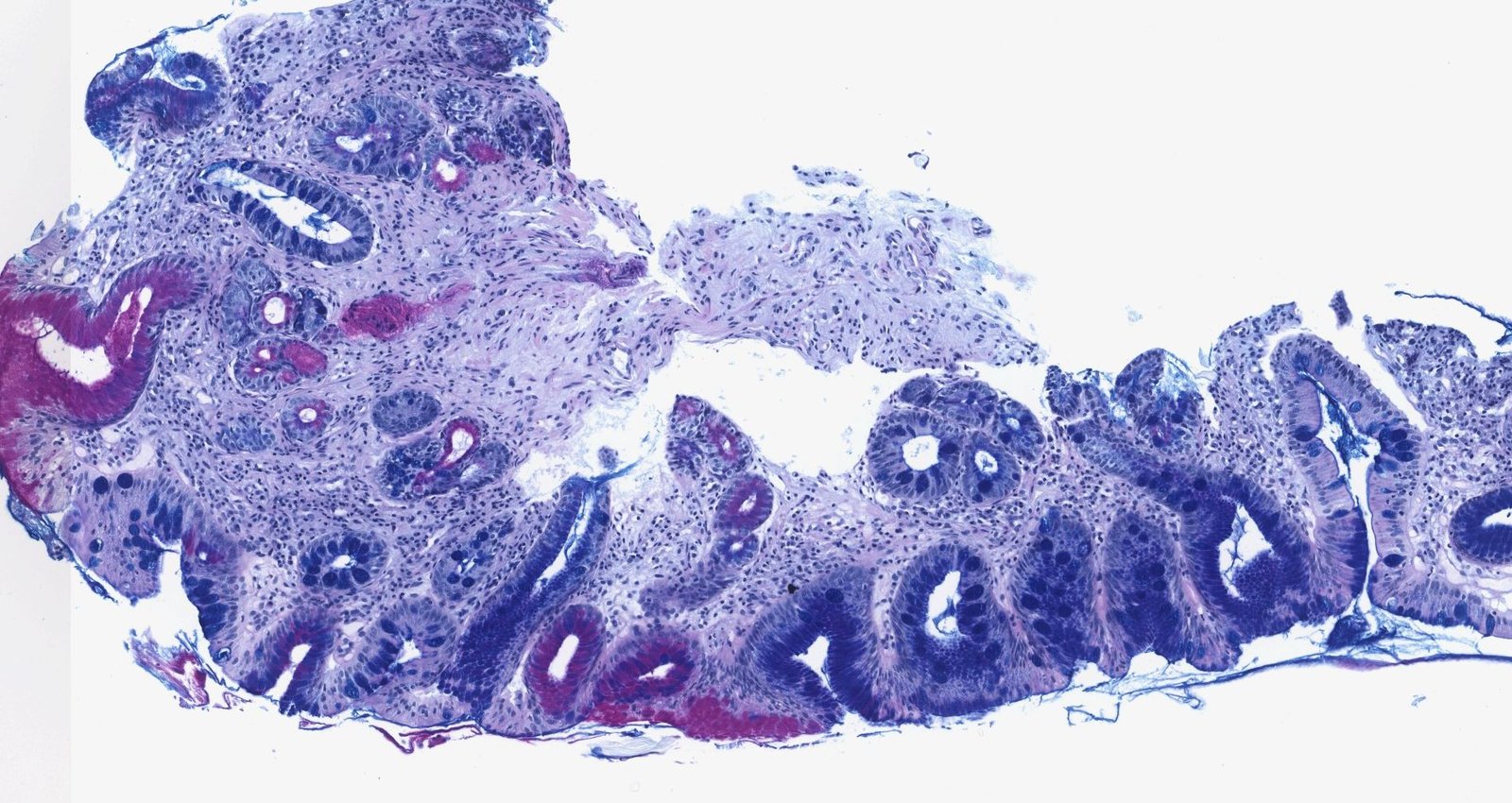 Barrett esophagus