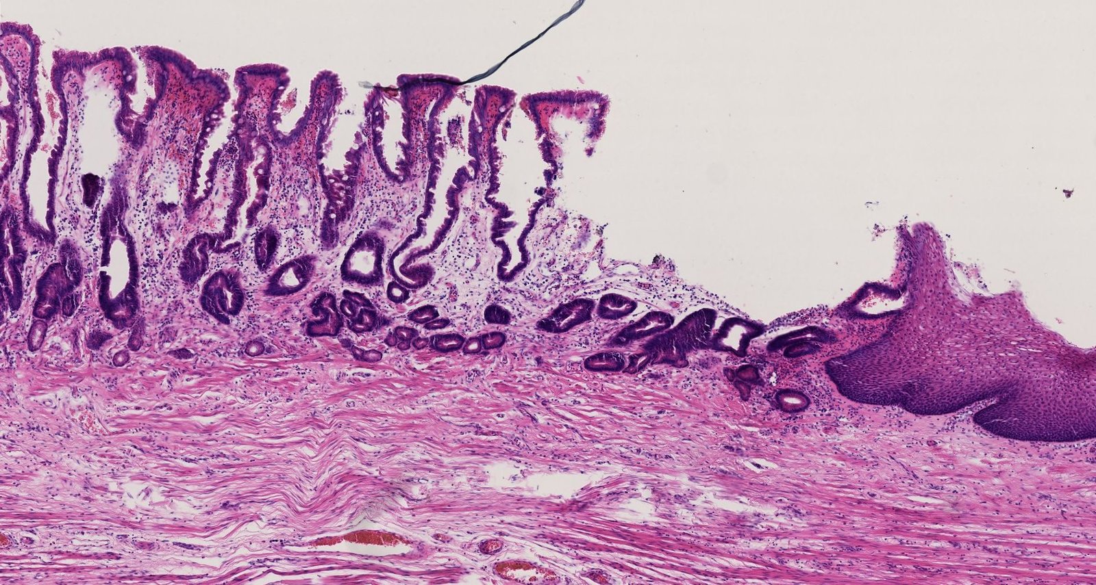 Barrett esophagus