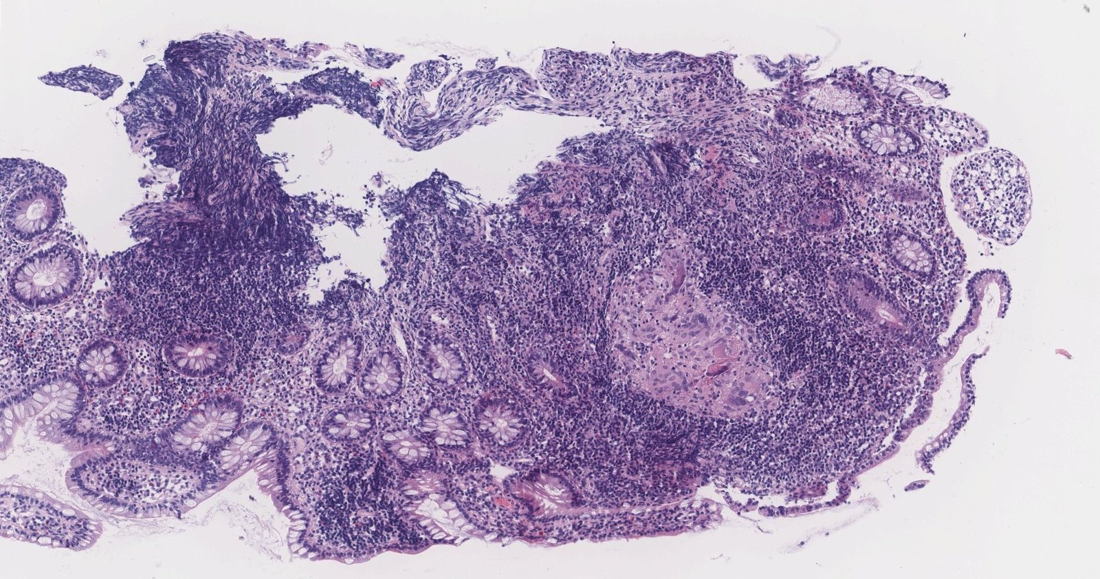 Crohn disease