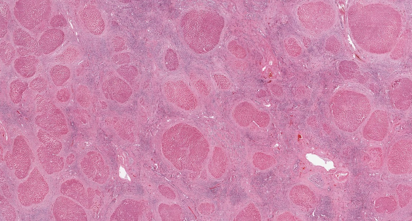 Liver cirrhosis