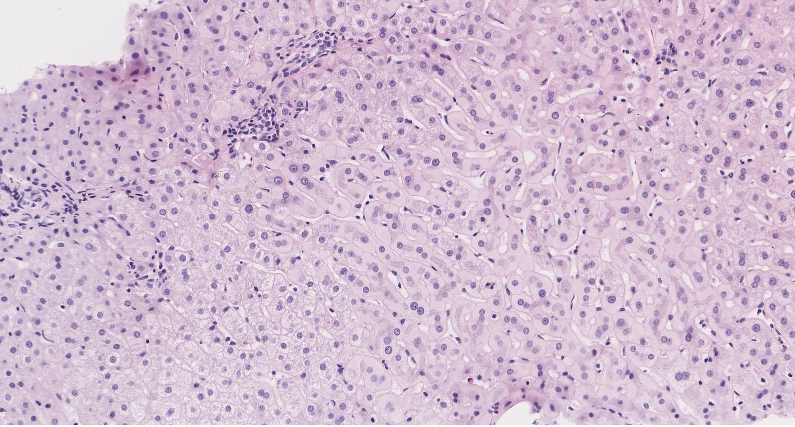 Histopathological changes in chronic hepatitis B