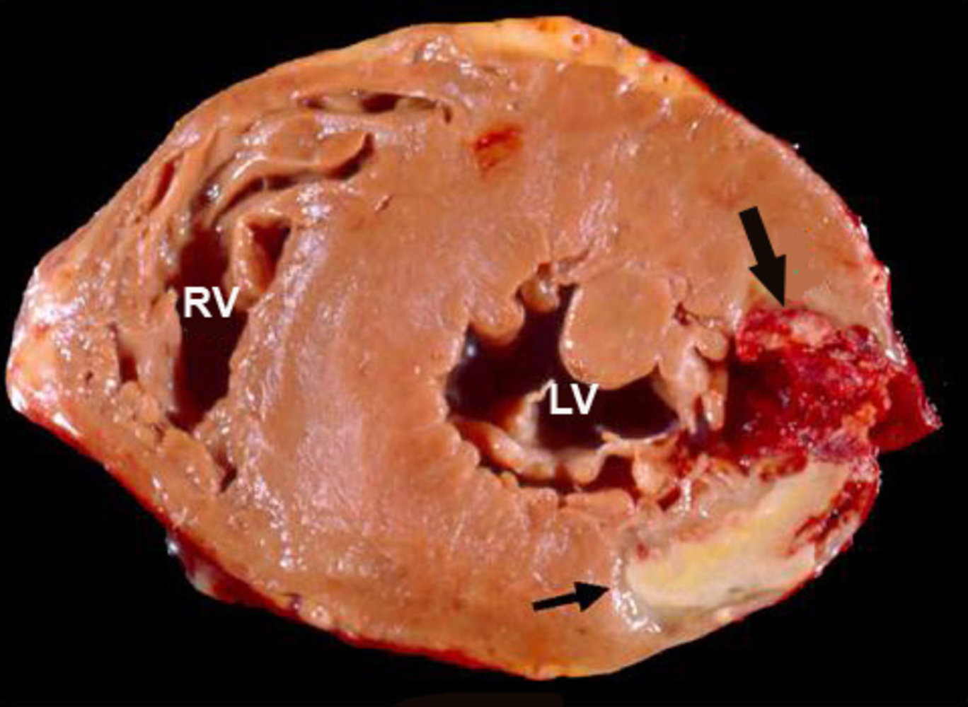 Posterolateral myocardial infarction with secondary wall rupture