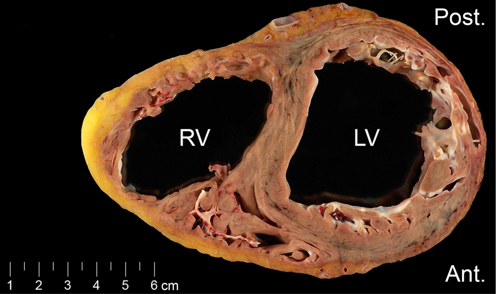 Arrhythmogenic right ventricular cardiomyopathy