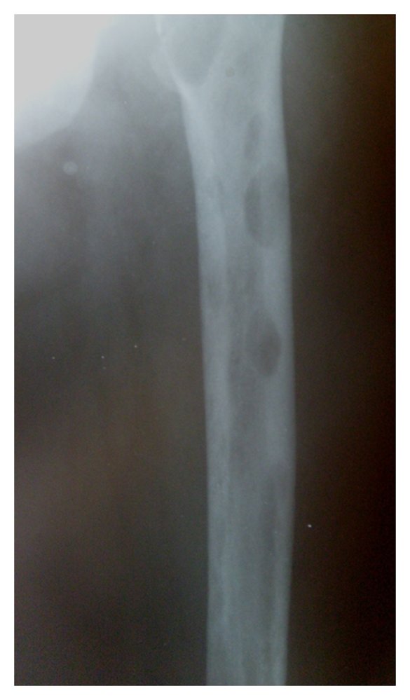 Brown tumors