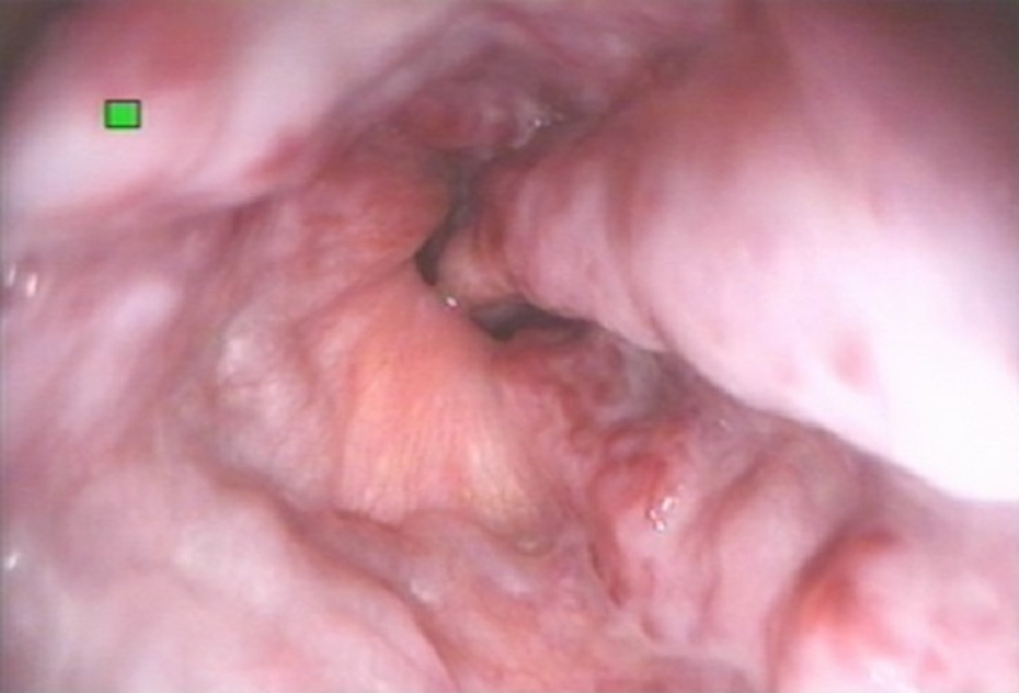Esophageal varices