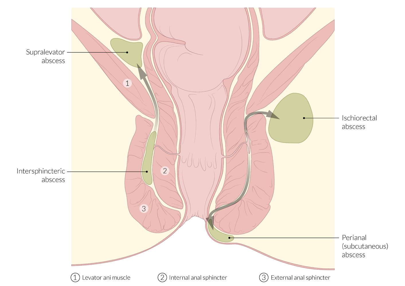Anal abscess