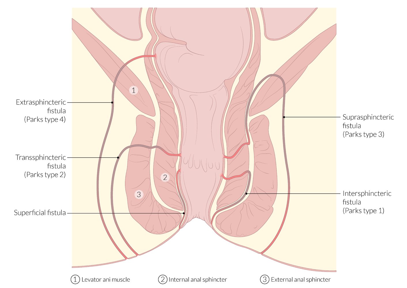 Anal fistula