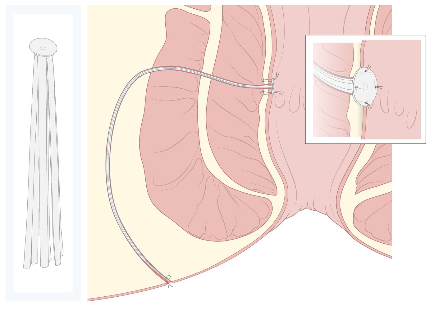 Fistula plug