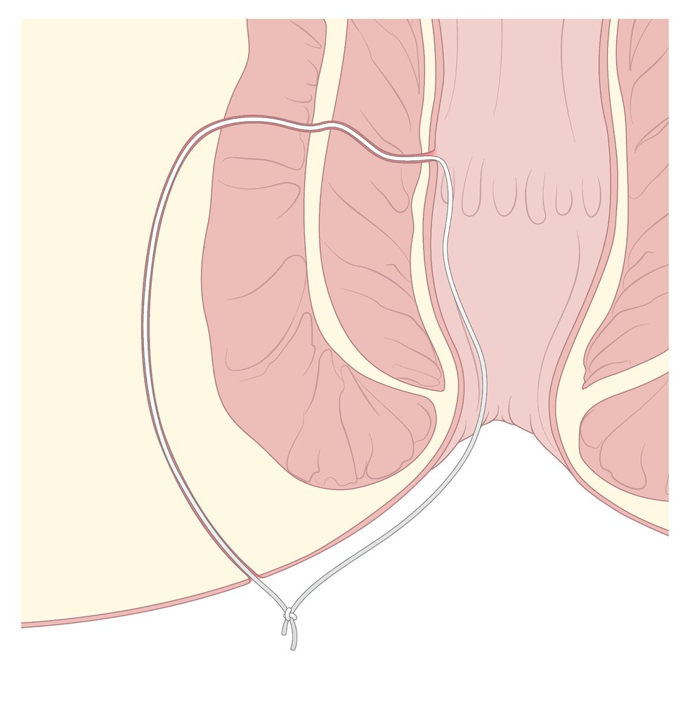 Seton placement in anal fistula