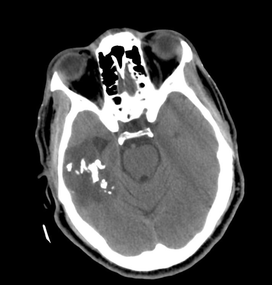 Oligodendroglioma