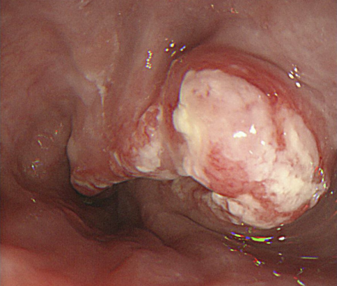 Esophageal carcinoma
