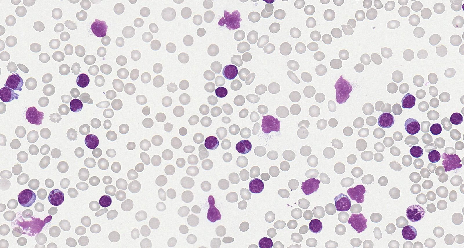 Smudge cells in chronic lymphocytic leukemia (peripheral blood smear)
