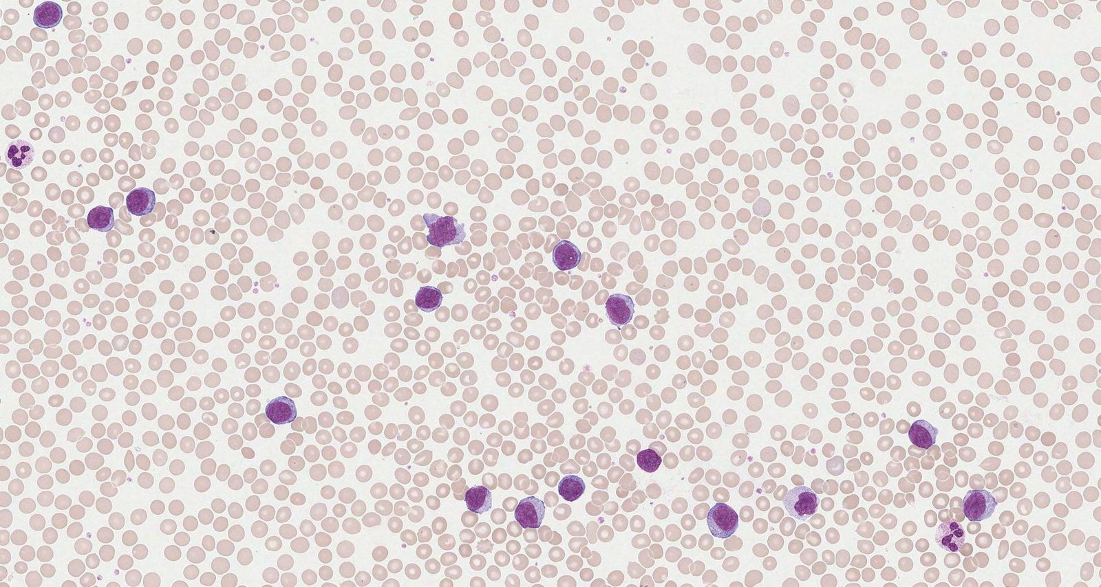 Acute lymphoblastic leukemia