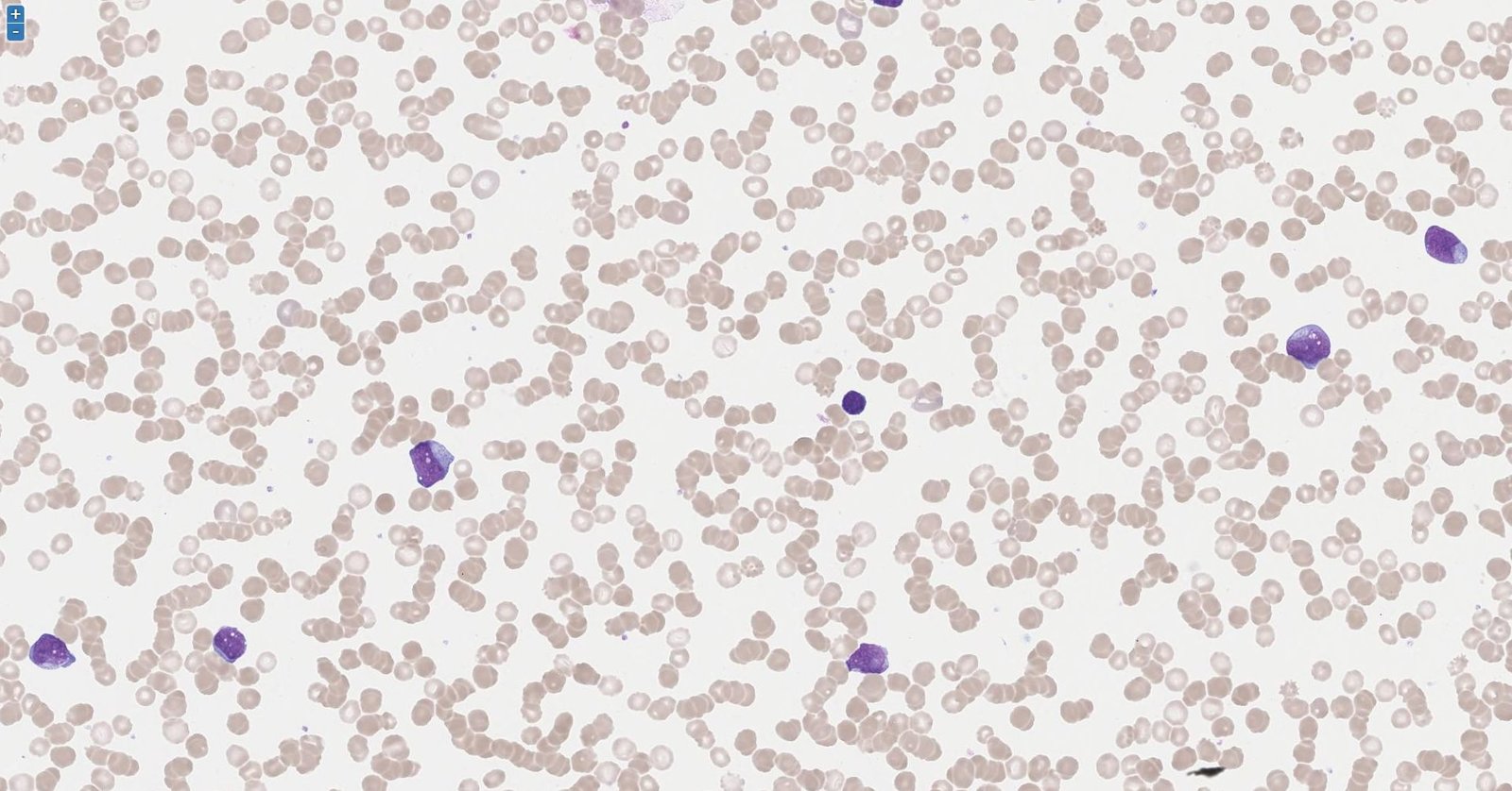 Acute myeloid leukemia