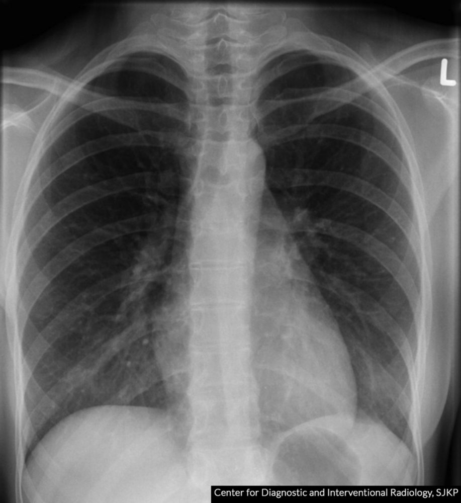 Lobes of the lung