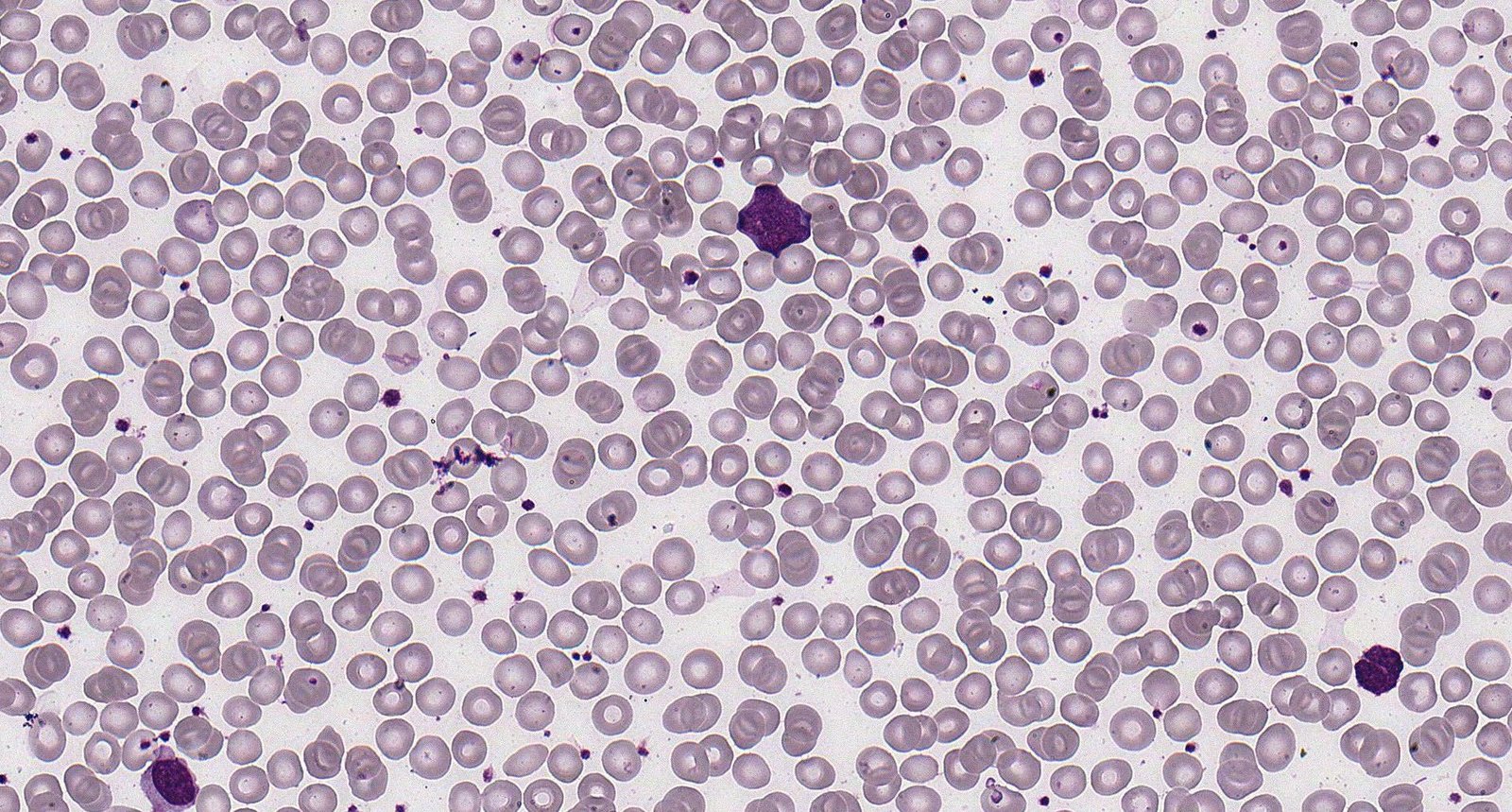 Follicular lymphoma (peripheral blood smear)