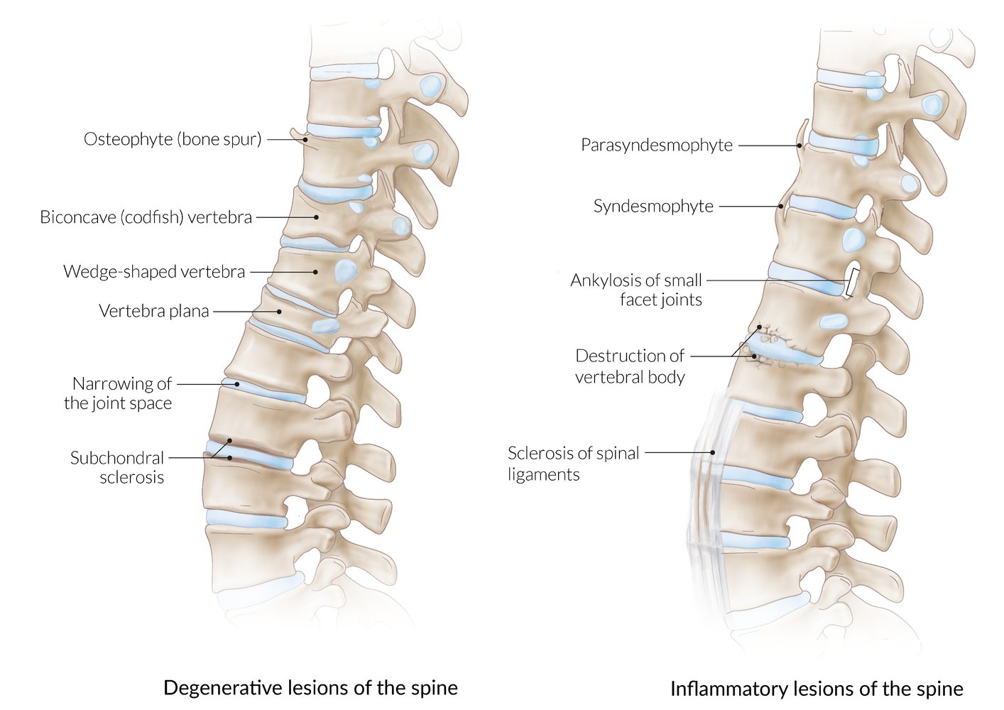 Degenerative and inflammatory lesions of the spine