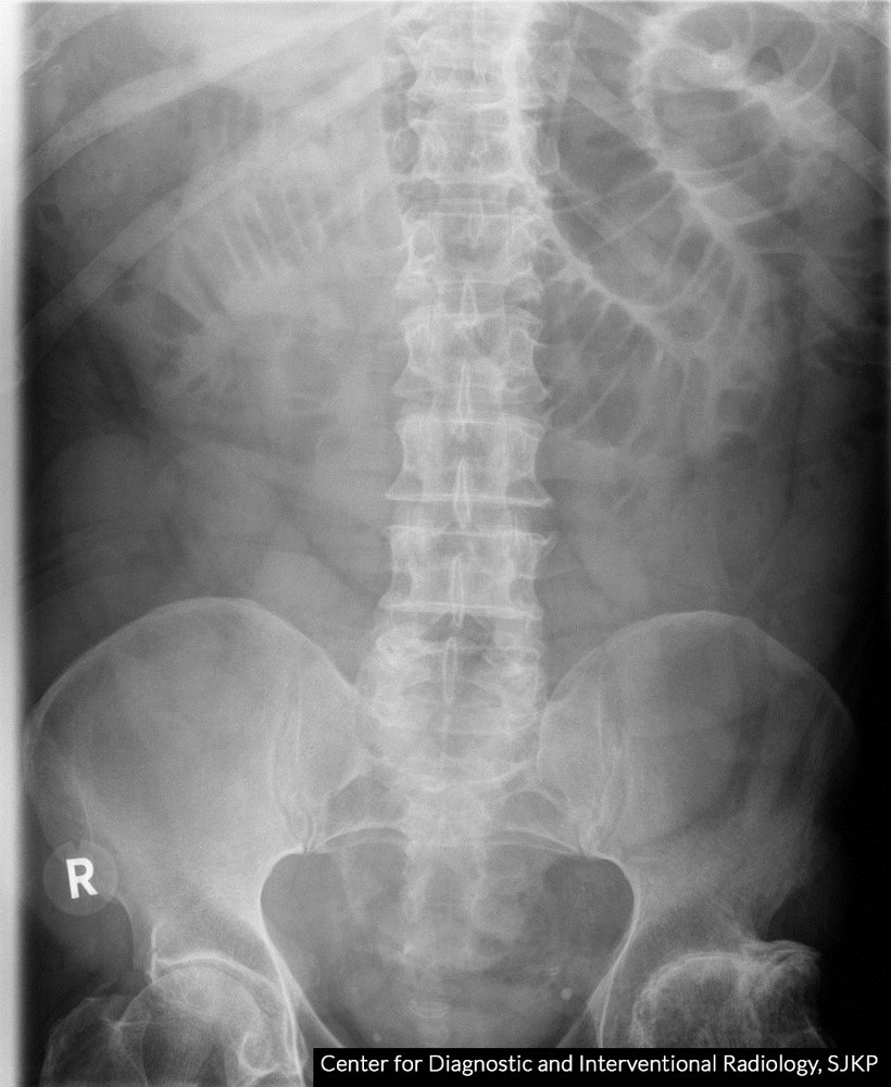 Small bowel dilatation