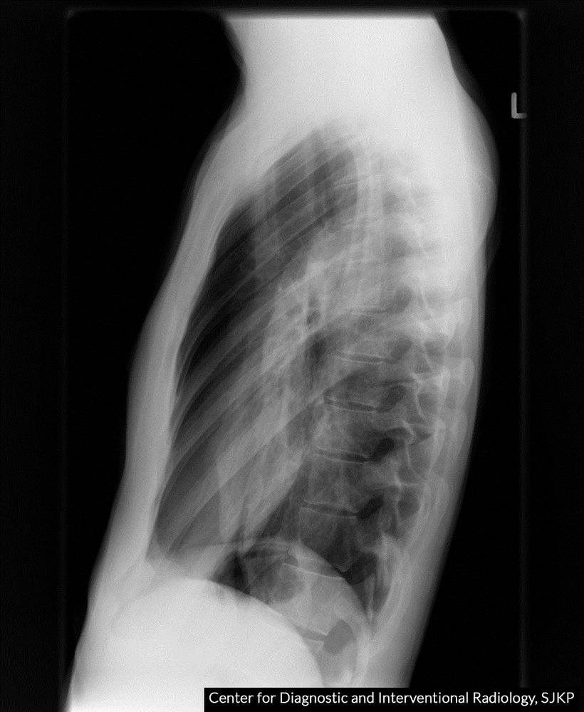 Pneumothorax