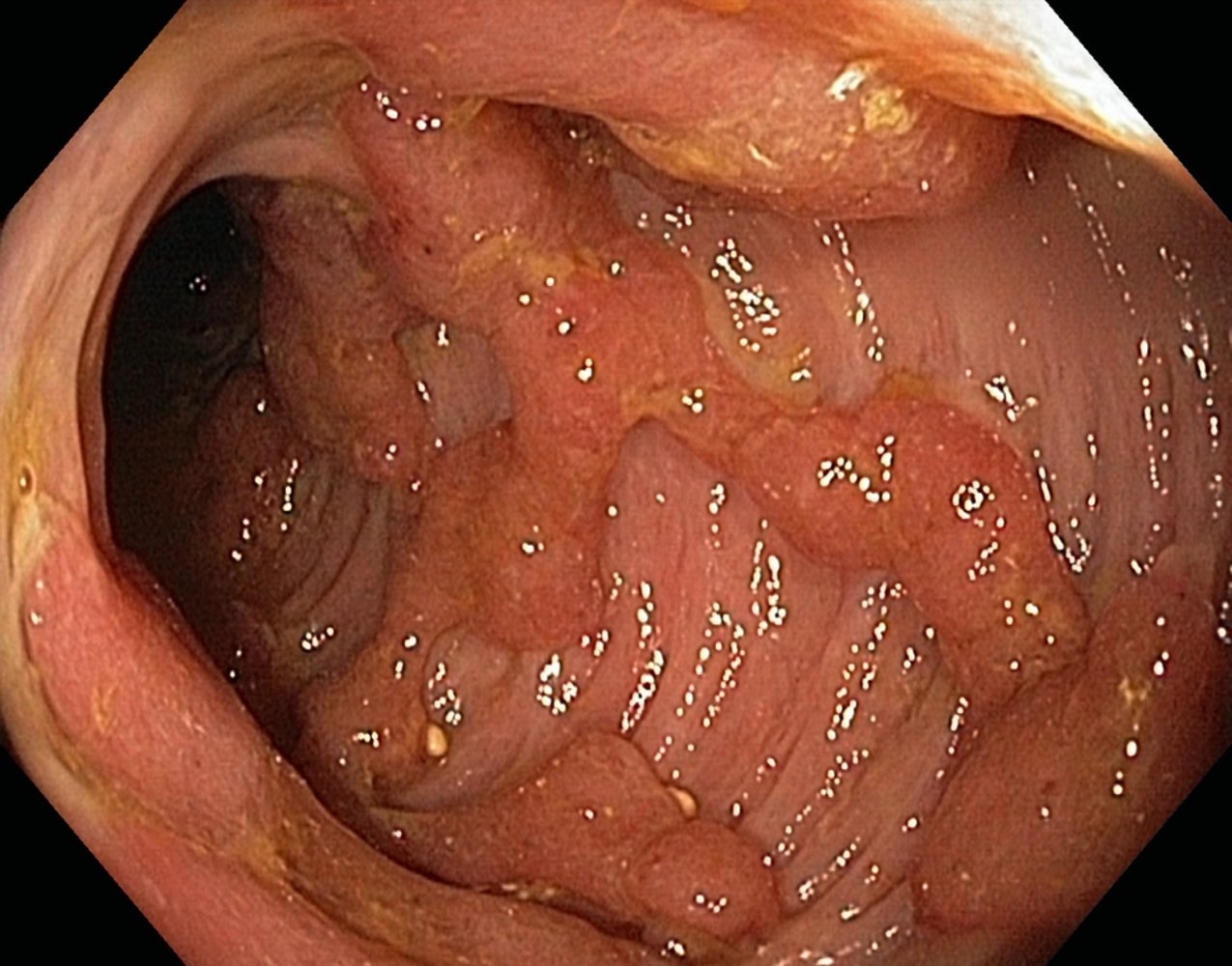 Pseudopolyps in advanced ulcerative colitis