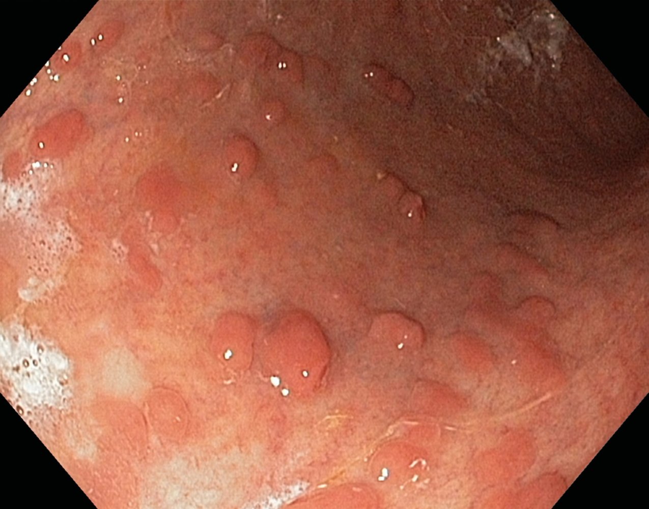 Pseudopolyps in advanced ulcerative colitis