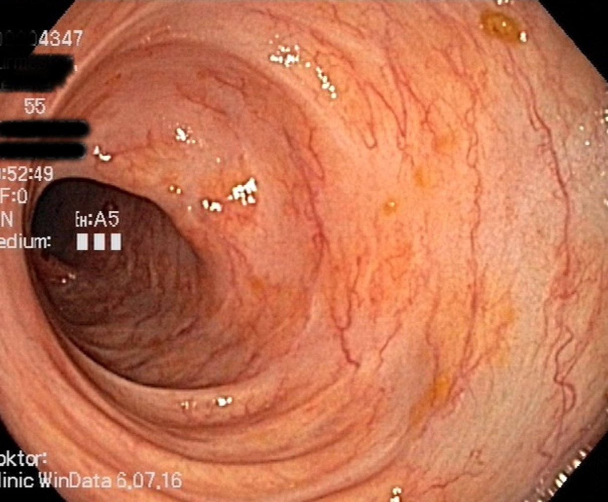 Ulcerative colitis in remission