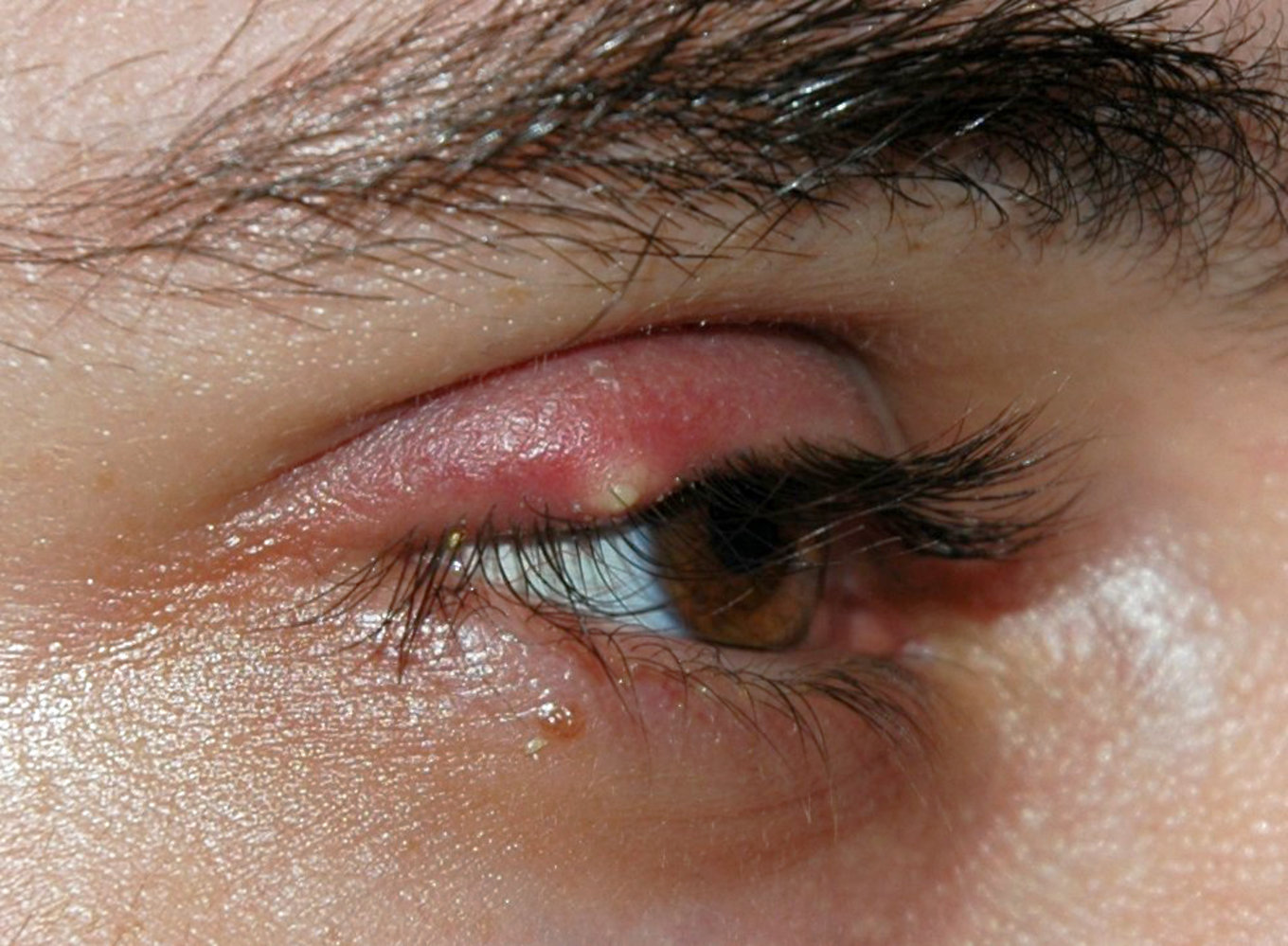 External hordeolum