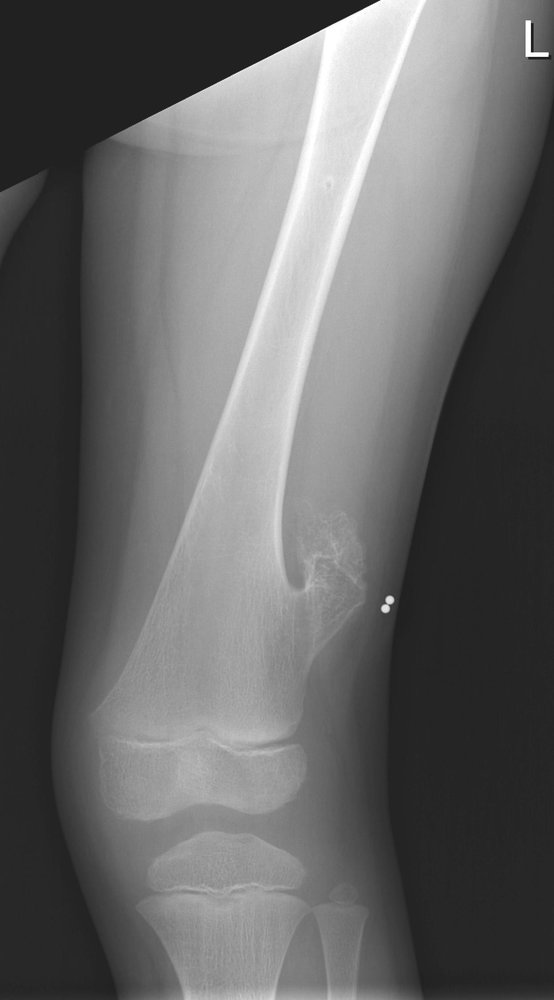 Osteochondroma of the femur