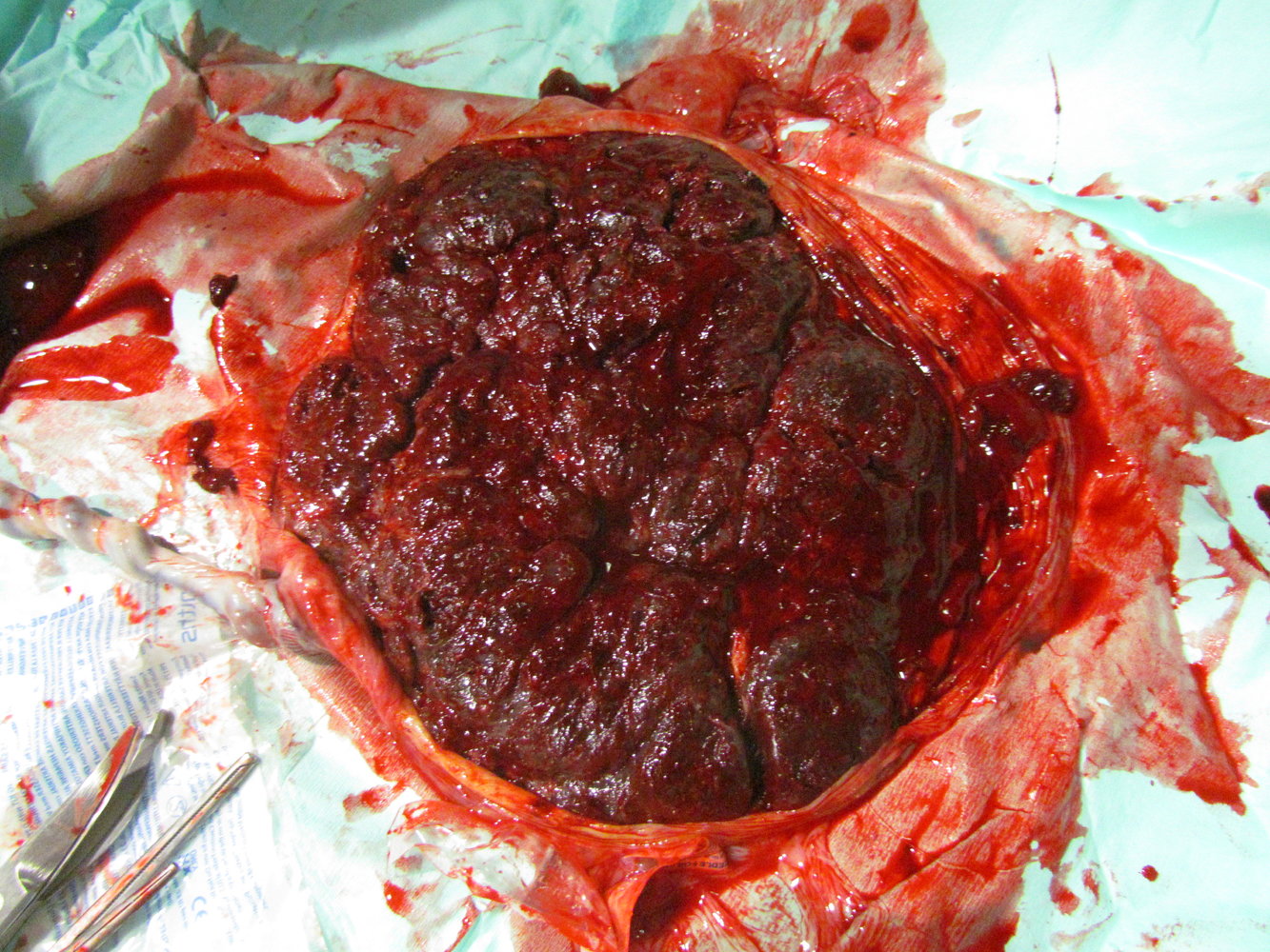 Placenta (maternal side)