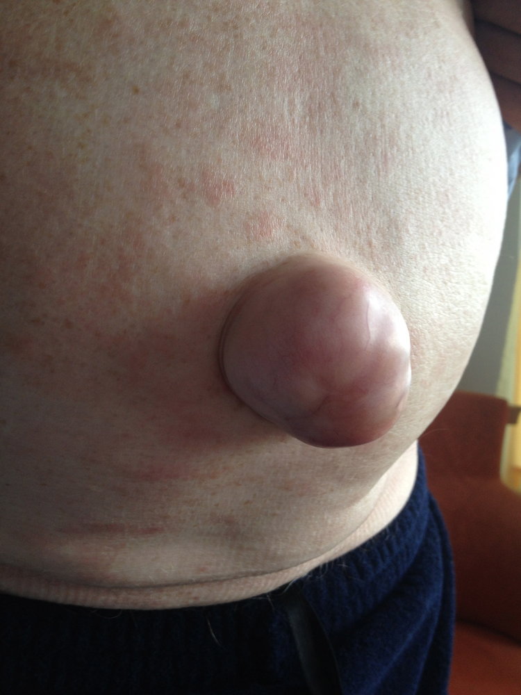 Umbilical hernia