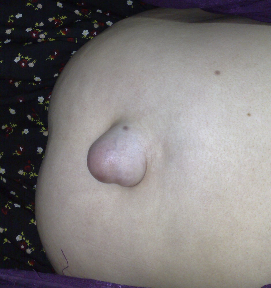 Paraumbilical hernia