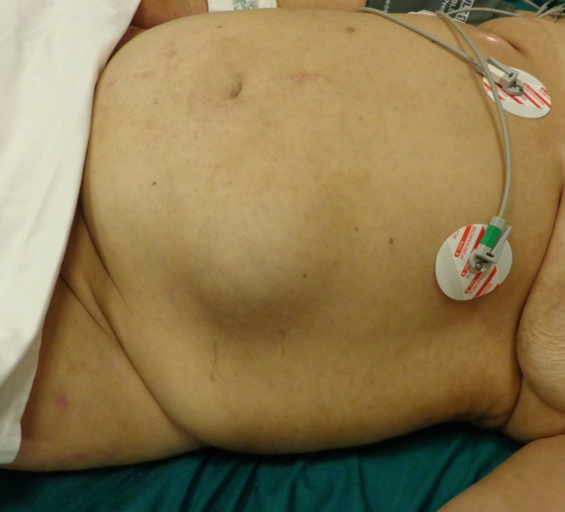 Spigelian hernia
