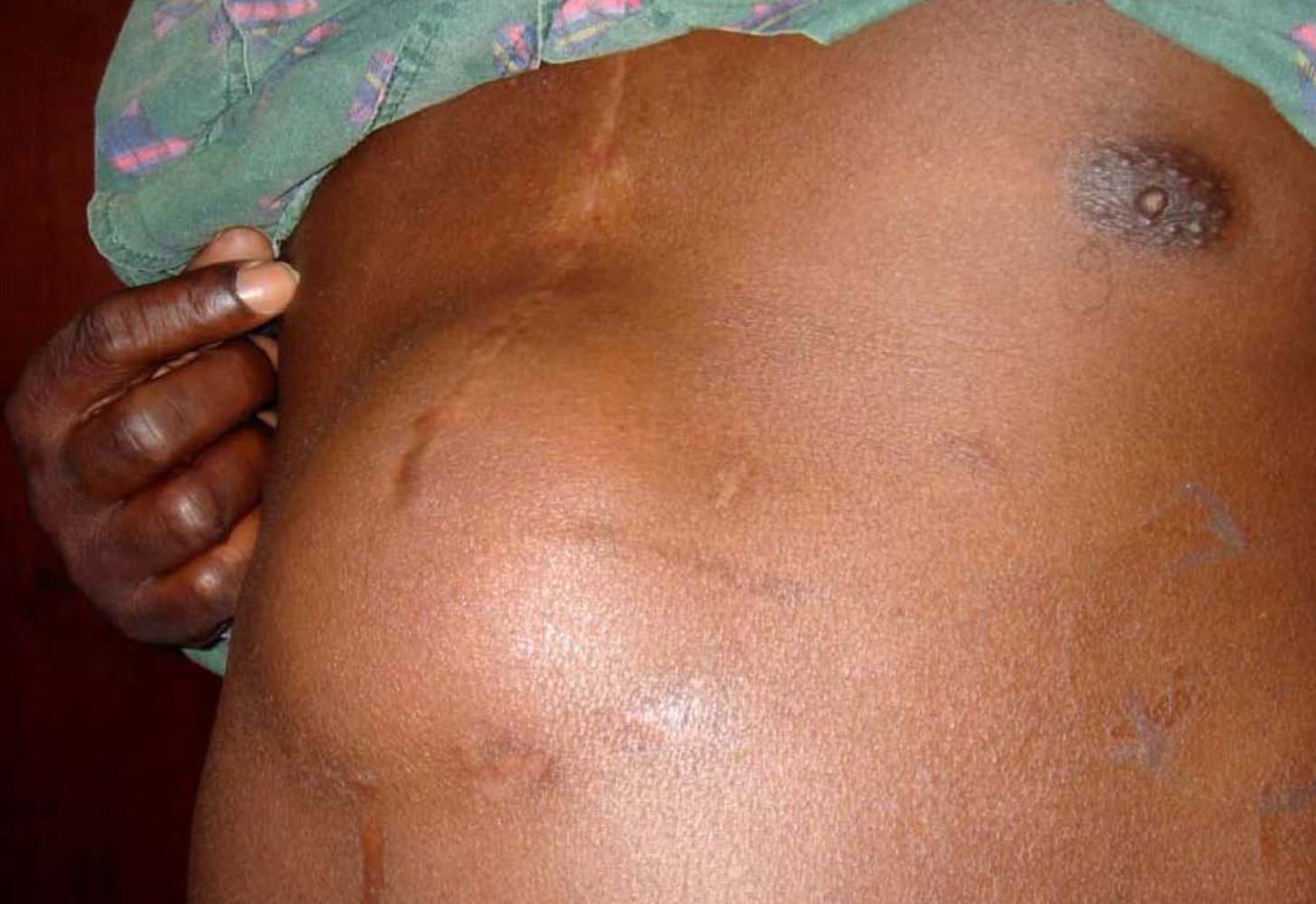 Incisional hernia