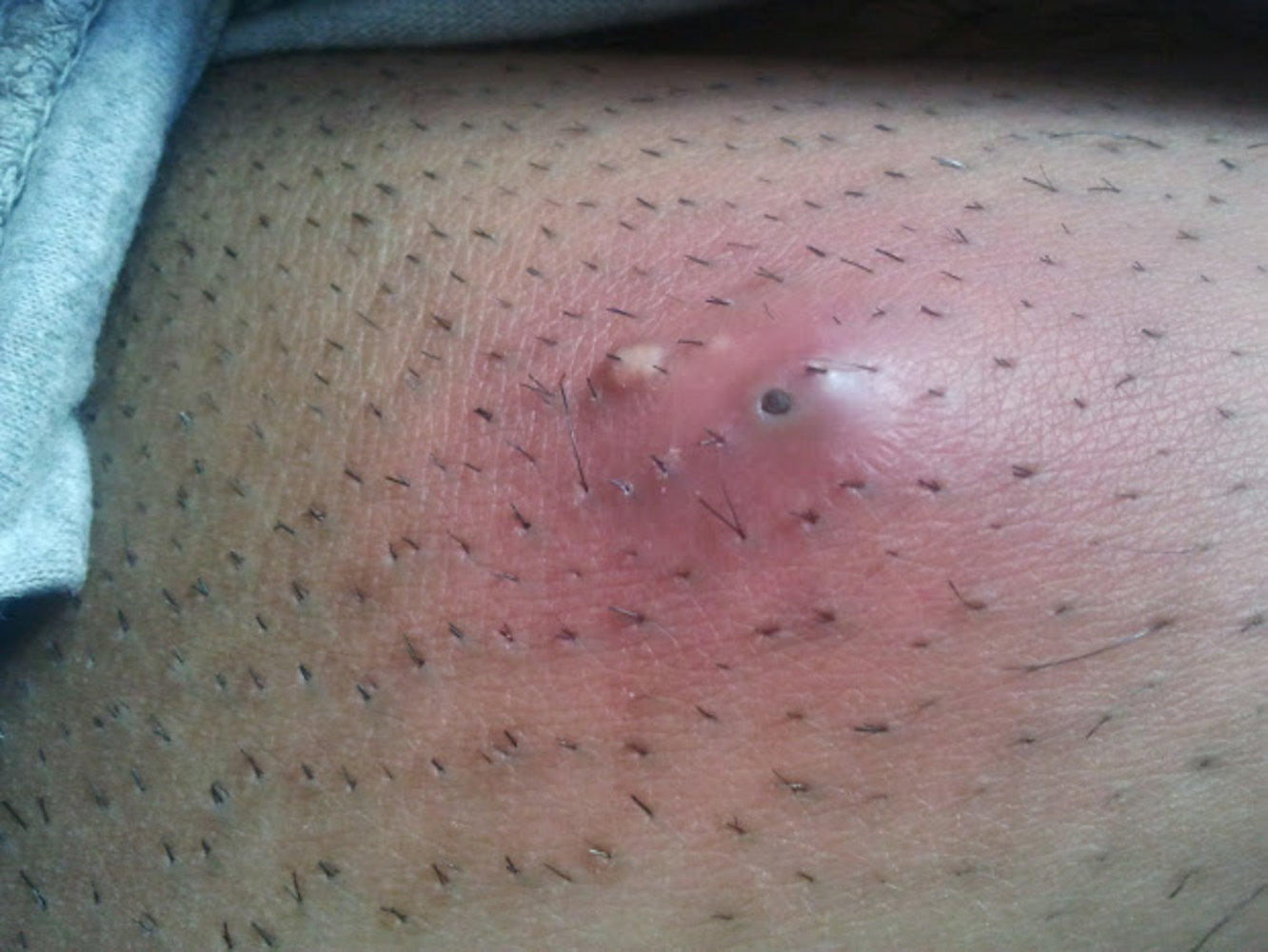 Skin abscess