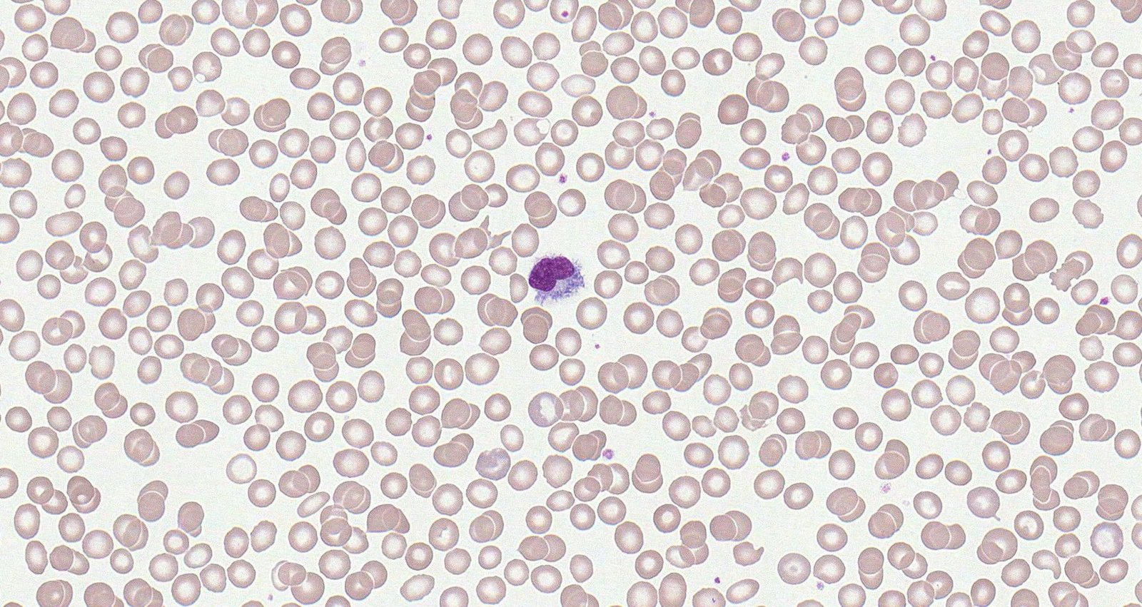 Hairy cell leukemia