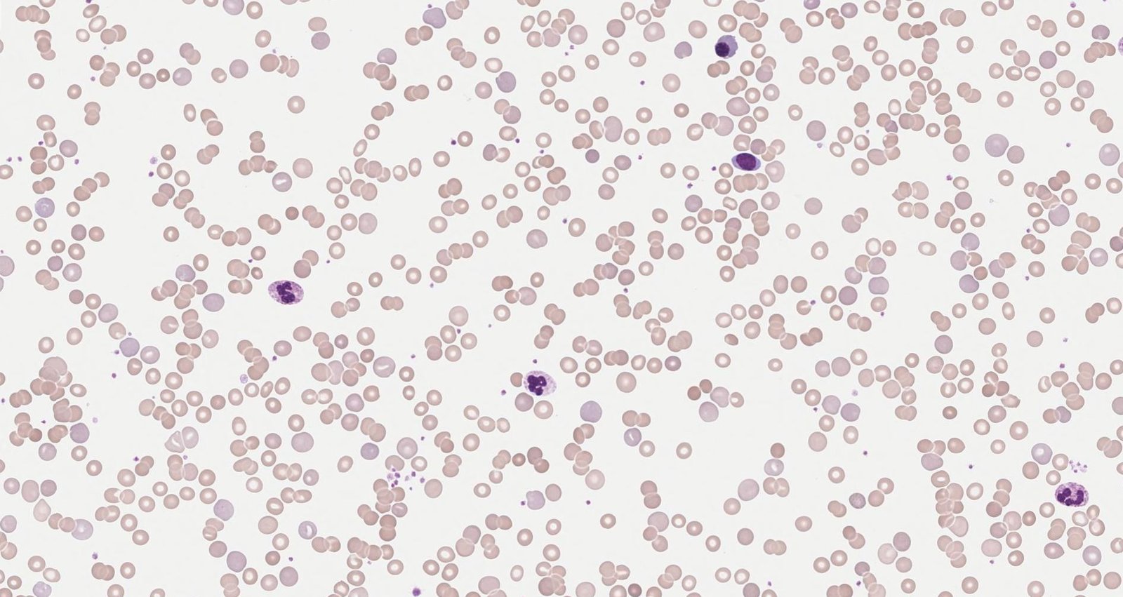 Hemolytic anemia (peripheral blood smear)
