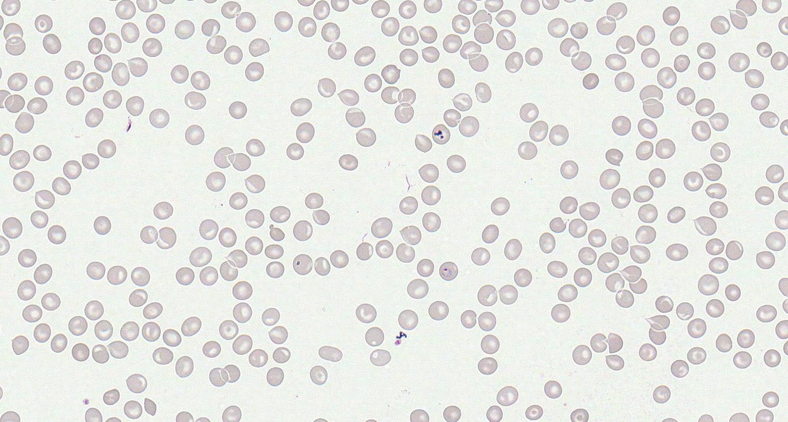 Malaria (peripheral blood smear)