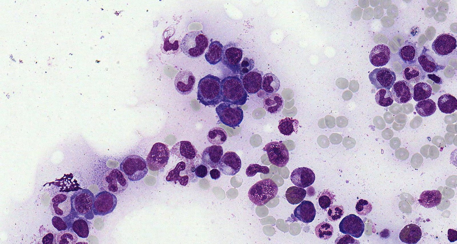 Megaloblastic anemia